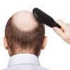 Kebotakan Rambut
