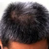 Rambut Beruban Sebelum 40tahun