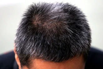 Rambut Beruban Sebelum 40tahun