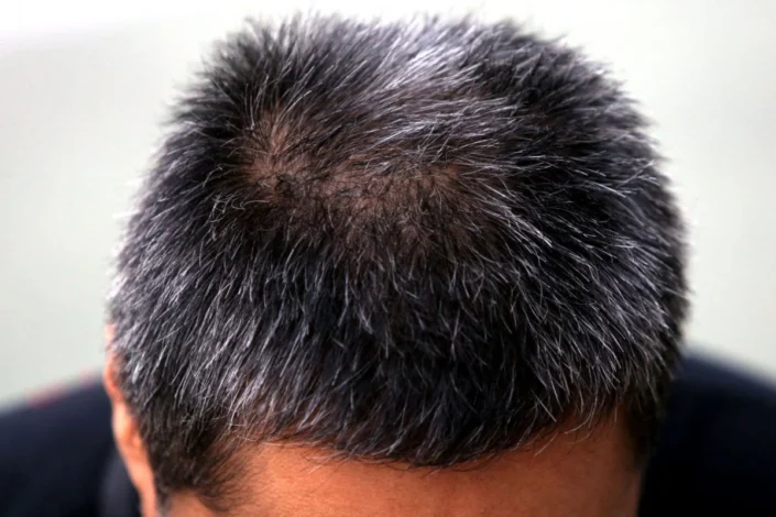 Rambut Beruban Sebelum 40tahun