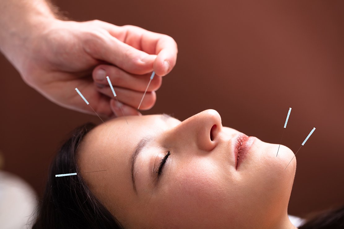 Acupuncture Treatment On Face