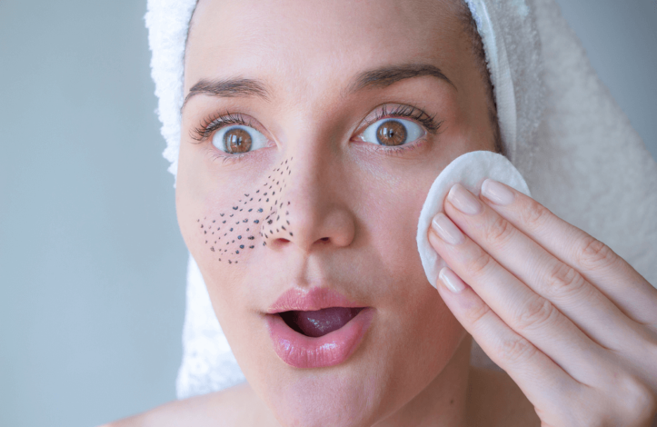 10 Cara Menghilangkan Bintik Hitam di Wajah, Ketahui Dulu Penyebabnya Face Black Dot