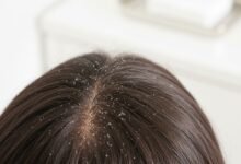 Mengatasi Ketombe Kering 1 cr