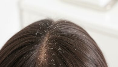 Mengatasi Ketombe Kering 1 cr