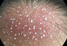 Review 5 Shampoo Anti Ketombe Paling Ampuh 1 cr