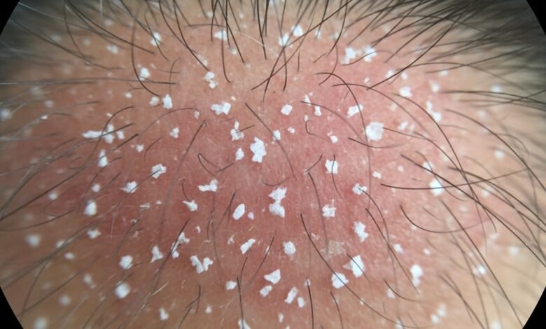 Review 5 Shampoo Anti Ketombe Paling Ampuh 1 cr